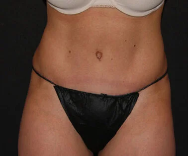 TUMMY TUCK (ABDOMINOPLASTY) - Hall & Wrye – Plastic Surgery and Medical Spa  in Reno NV, Breast Implants and Breast Augmentation, Liposuction, Tummy- Tucks, Dermal Fillers, Hair Transplants and more! Licensed Reno Plastic